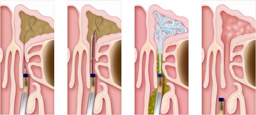 Balloon Sinuplasty Surgery